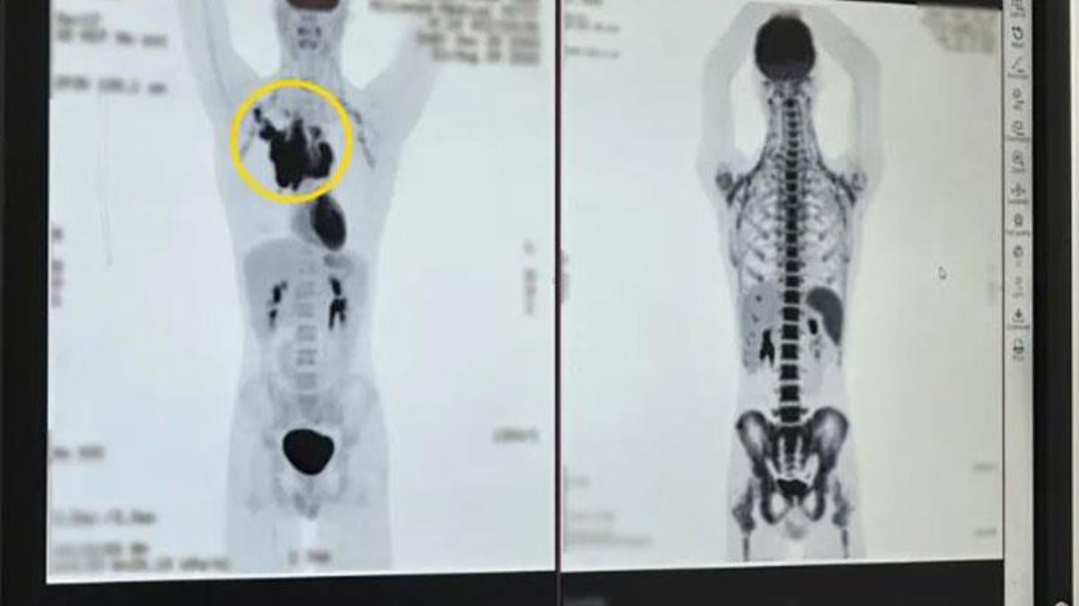 Omzundan “Tık” diye ses duyan genç, hastanede gittiğinde kanser olduğunu öğrendi