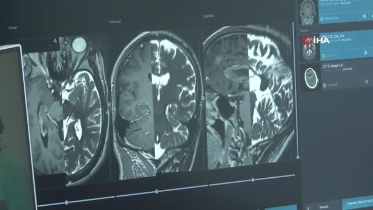 Epilepsi hastası şifayı Türkiye’de beyin pili ameliyatında buldu