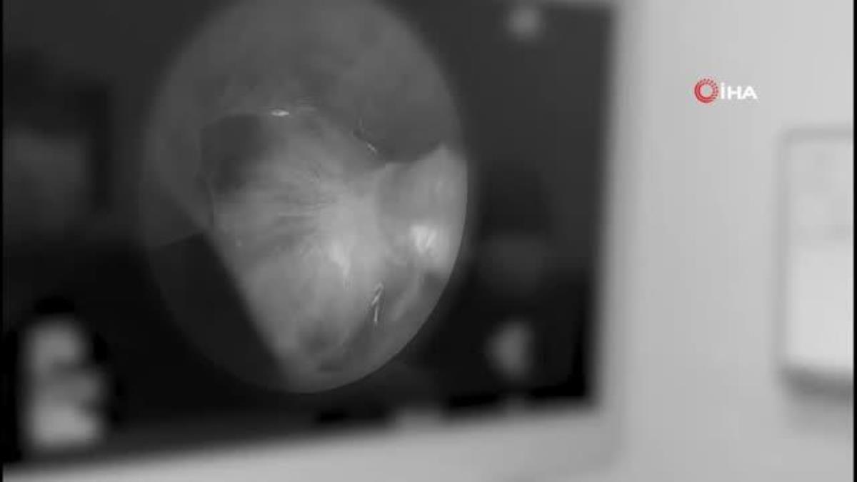 Nefes alamayan KOAH hastalarını koşturan tedavi: Rezektör balon tedavisi