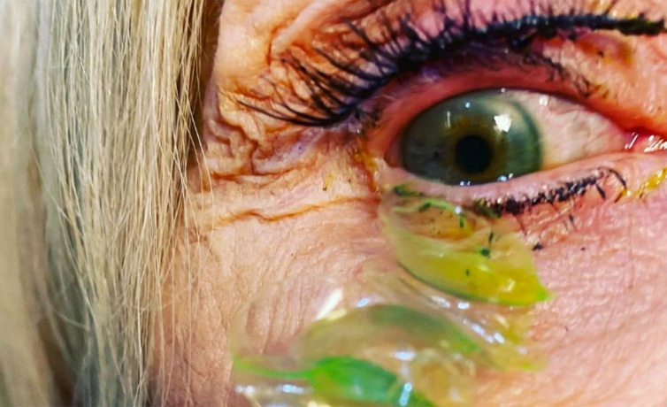 Gözünüzdeki lensi çıkarmazsanız ne olur? Bir kadın 23 gün boyunca bunu yaptı sonuç şok!